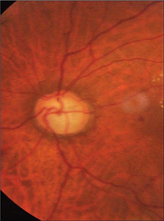 Generalized arteriolar constriction: Grade 1 hypertensive retinopathy