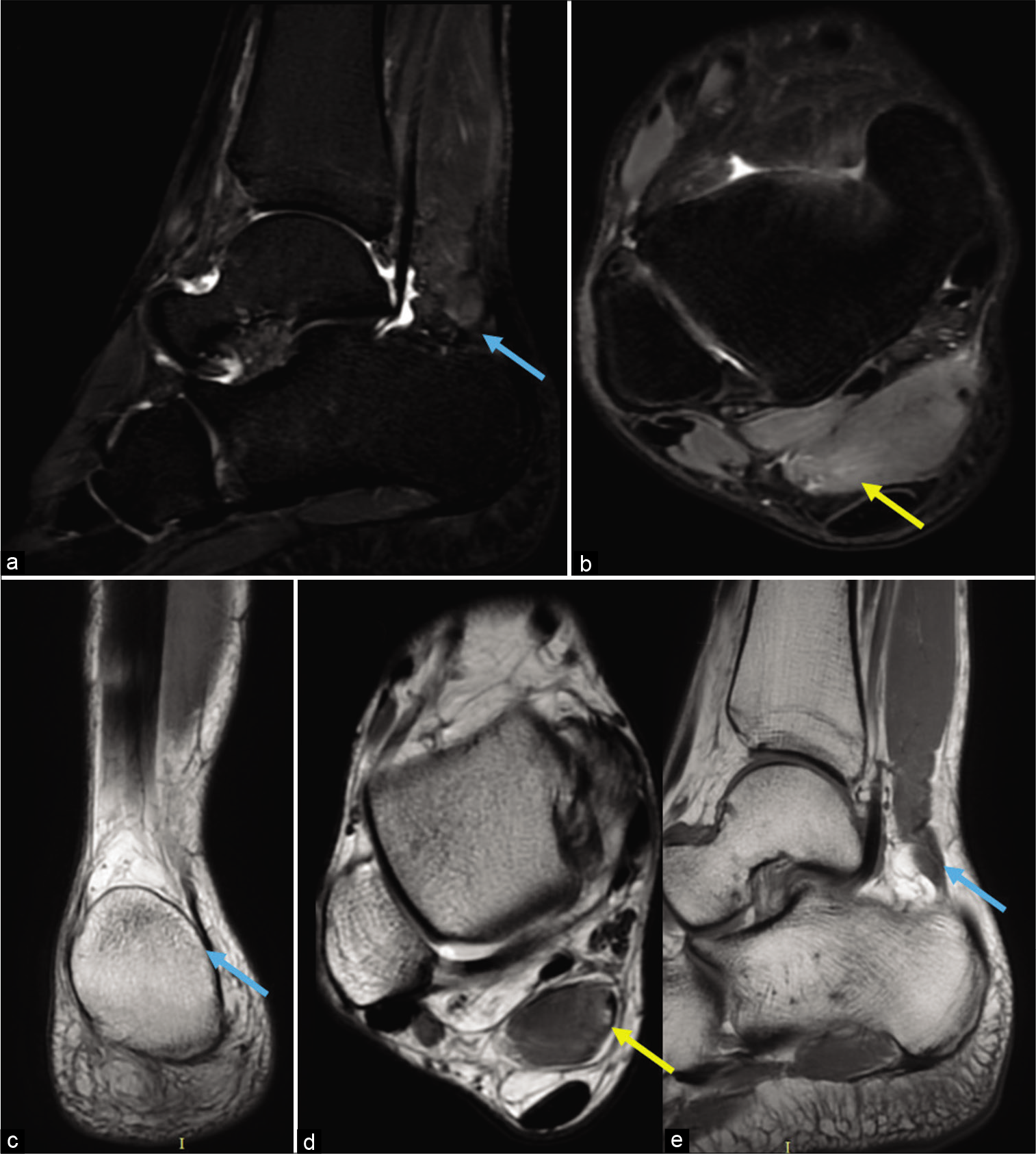 Story of a superfluous muscle accessory soleus muscle sprain Imaging