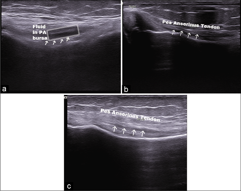 (a) Fluid (box) in pes anserinus bursa. (b) Pes anserinus tendon with altered echogenicity (arrow) and fluid tracking. (c) Pes anserinus tendon with altered echogenicity (arrow).