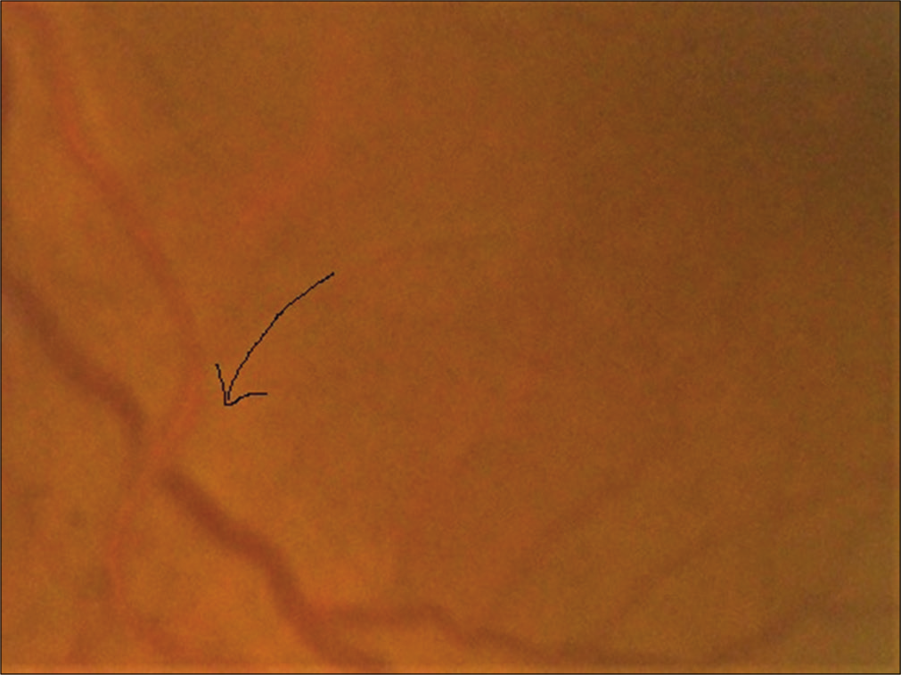 Salus sign: Arrow showing acute deflection of retinal vein by the compression of atherosclerotic artery.