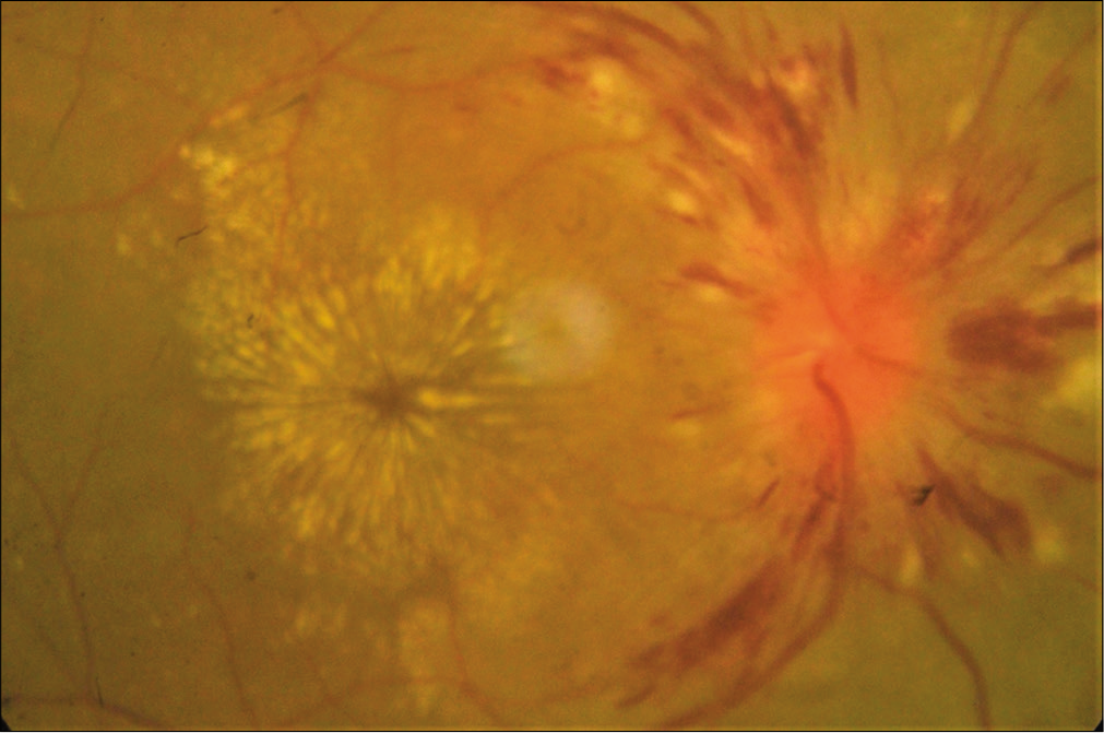 Hypertensive retinopathy Grade 4: Disc edema with flame-shaped hemorrhages, cotton wool spots, and macular edema with star-shaped exudate deposition.