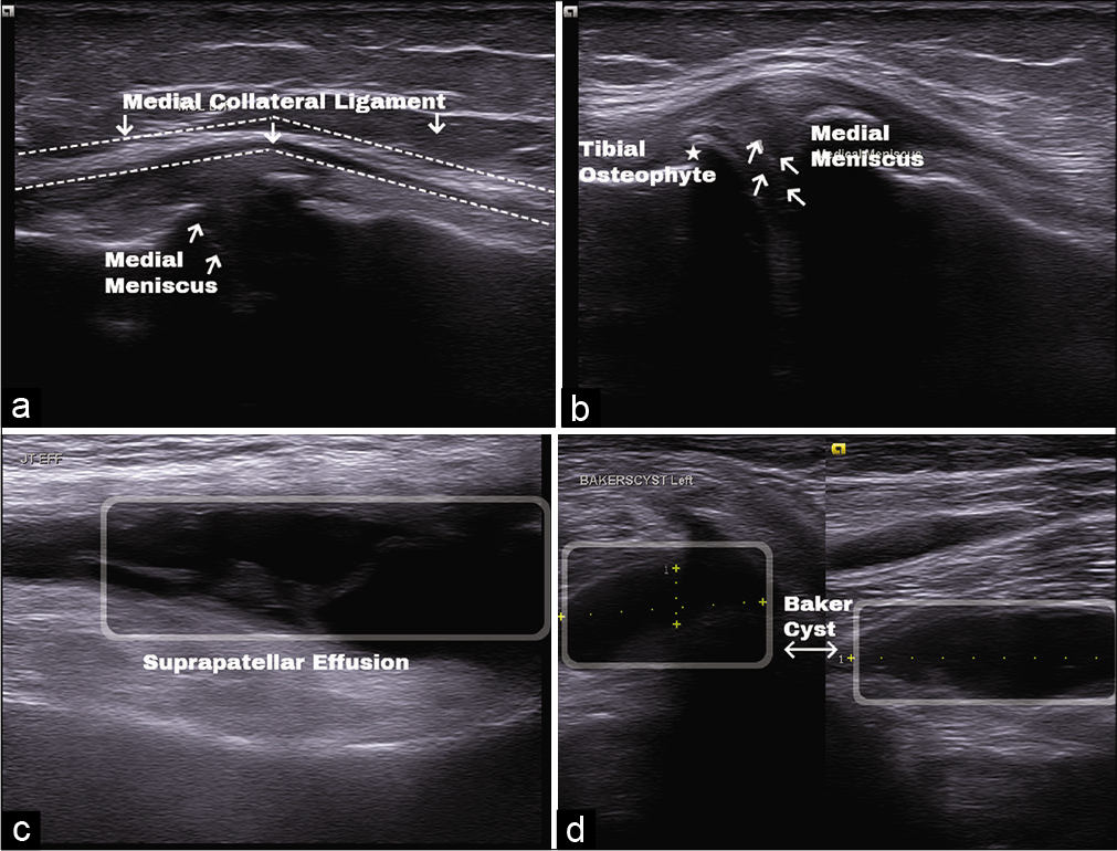 (a) Medial collateral ligament (dotted line) altered echogenicity with medial displacement and protrusion of medial meniscus (arrow). (b) Protrusion of body medial meniscus (arrow) and tibial osteophyte (star). (c) Joint effusion in suprapatellar recess (box). (d) Baker cyst (box) with short and long axis view.