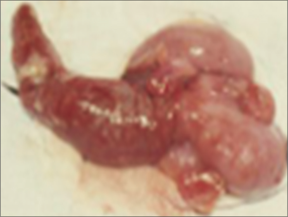 Surgical specimen showing an appendix with inflammation, hyperemia, and signs of necrosis.