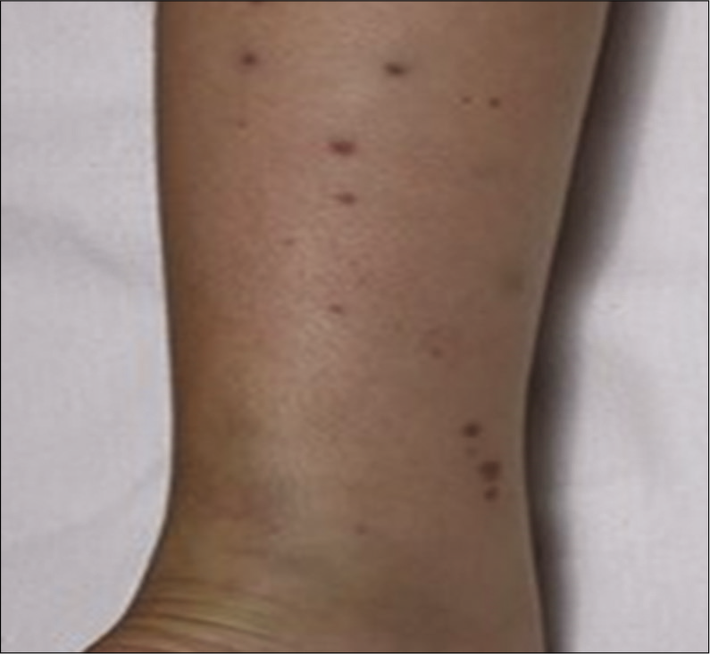 Palpable purpura in the lower limb.