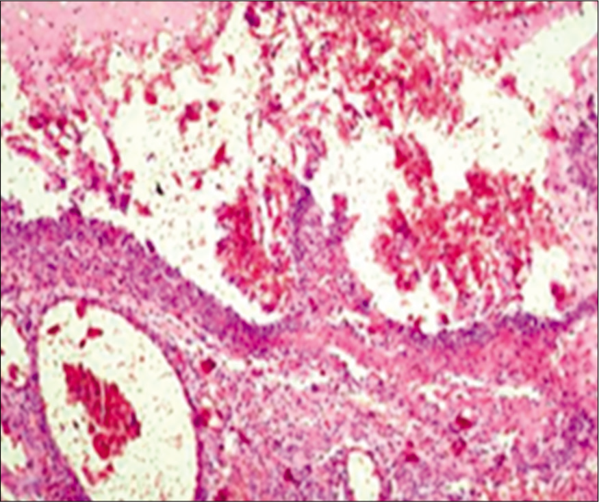 Acute appendicitis with fibrinopurulent exudate in all layers of the appendix.