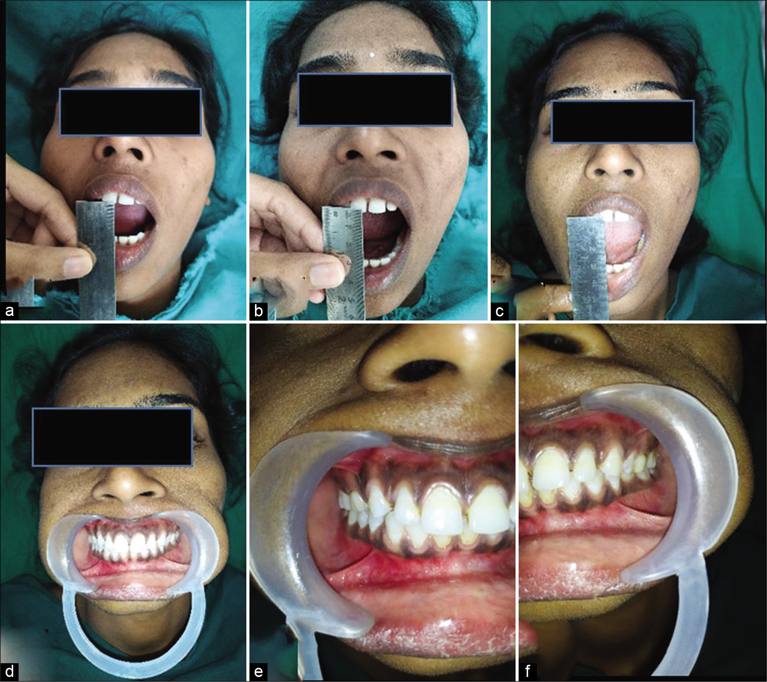 Post-operative. Maximum inter-incisal opening (a) 1st week: 26 mm, (b) 2nd week: 29 mm, (c) 3rd month: 32 mm, (d-f) no occlusal discrepancy present.