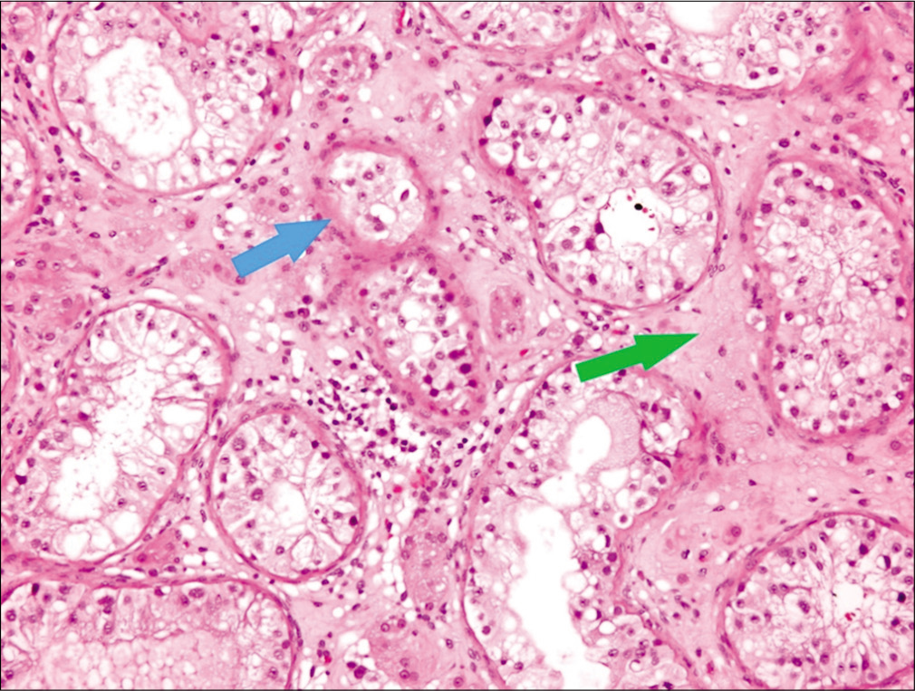 H&E stained slide ×10 showing atrophic seminiferous tubules (blue arrow) and peritubular fibrosis (green arrow).