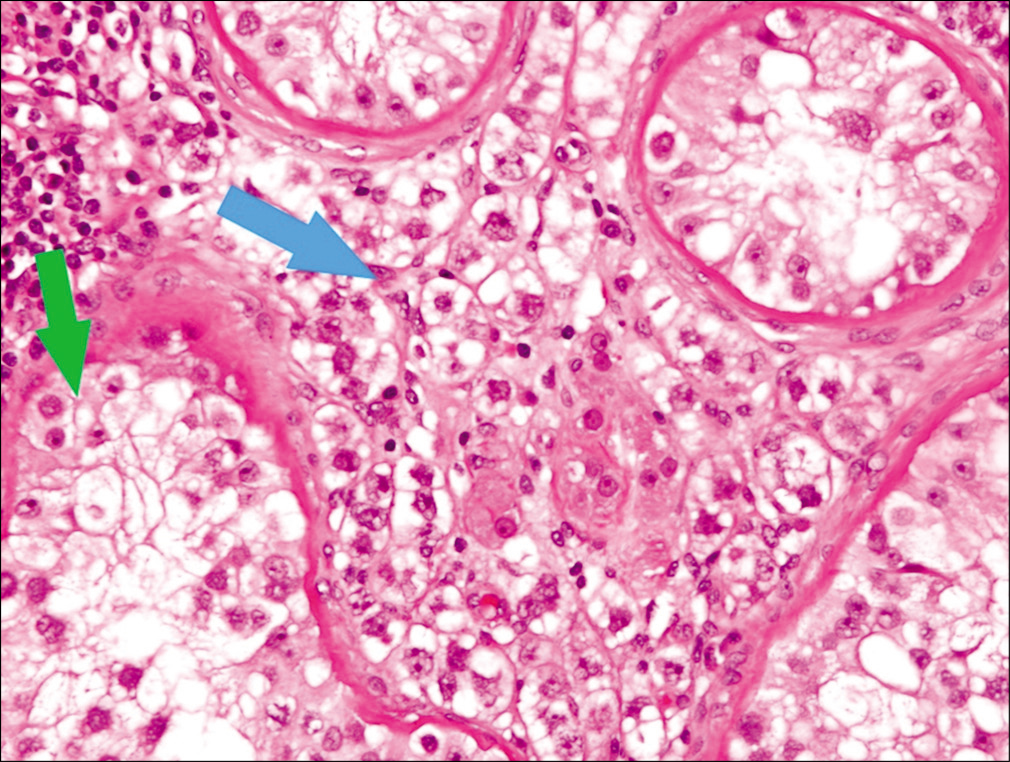 H&E stained slide ×20 showing intertubular seminoma cells (blue arrow) and intratubular germ cell neoplasia (green arrow).