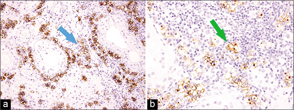 Immunohistochemistry, ×40 showing intertubular tumor cells surrounded by stromal lymphocytes highlighted by CD117 (blue arrow, a) and placental alkaline phosphatase (green arrow, b).