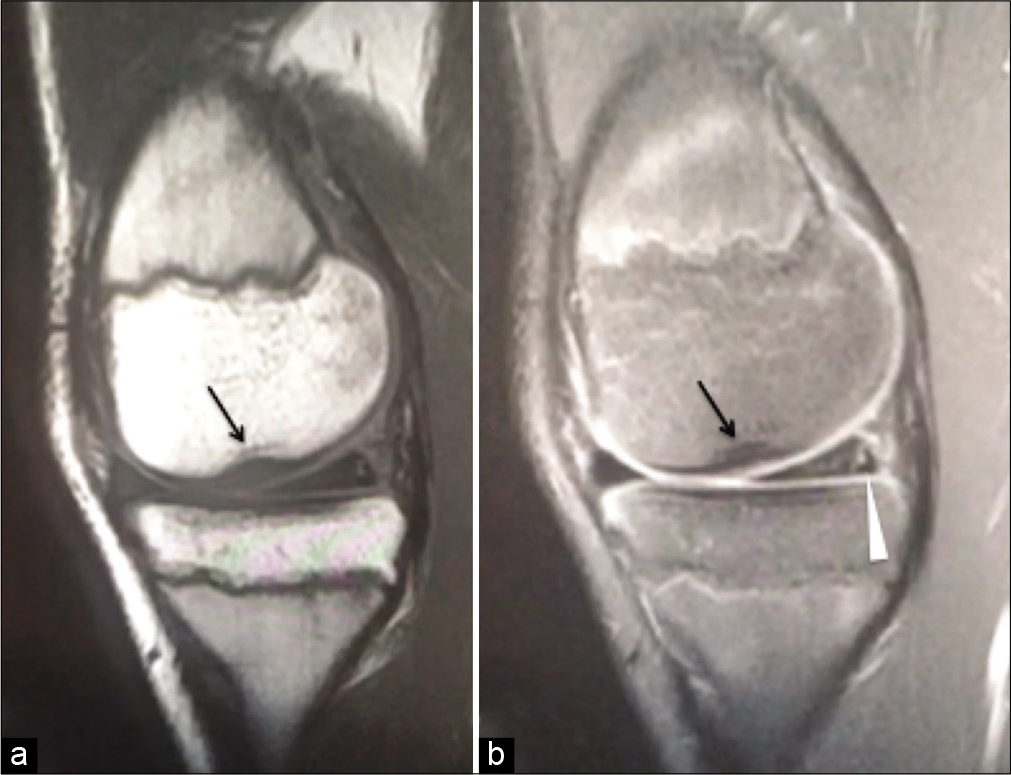 Sagittal PD (a) and PDFS (b) showing medial femoral notch sign (Gupta-Botchu sign) (arrow) and tear of the medial meniscus (arrowhead).