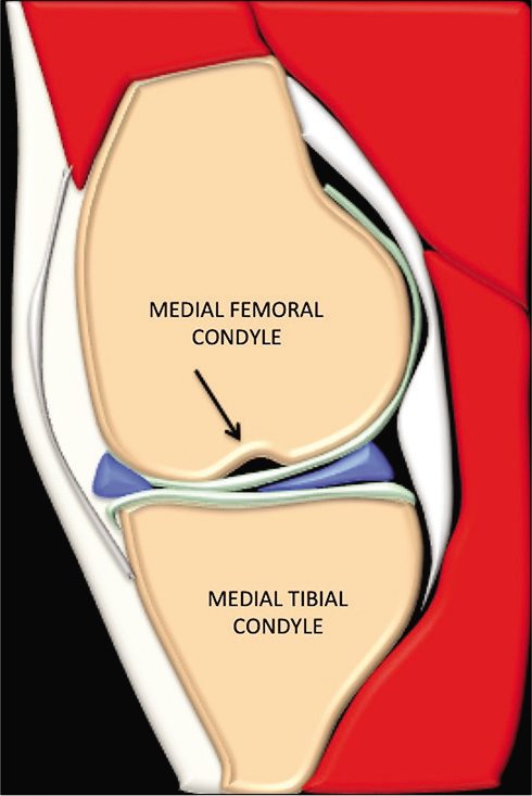 Animation of the sagittal image of the knee through midmedial femoral condyle showing the medial femoral notch sign (Gupta-Botchu sign) (arrow).