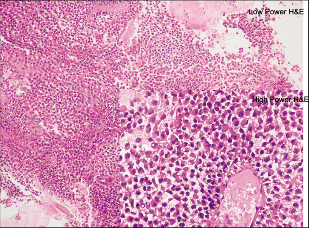 Low and high power H&E stain showing diffuse sheet-like growth of uniformly sized epithelioid cells with abundant amphophilic to eosinophilic cytoplasm, large vesicular nuclei, and frequent prominent nucleoli.