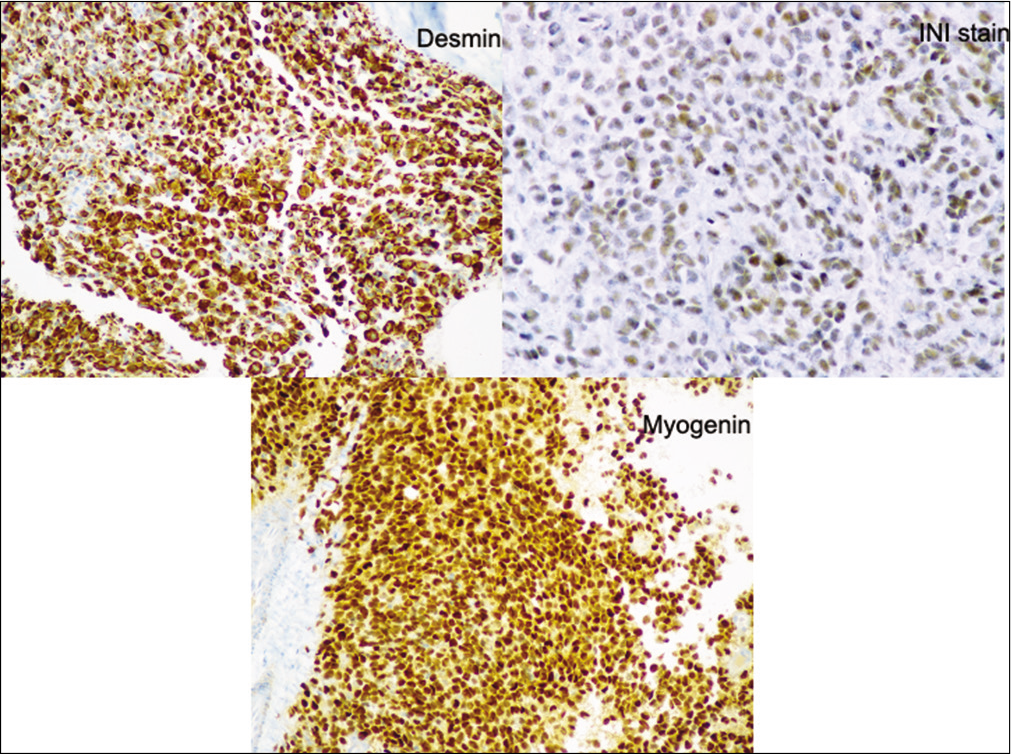 IHC suggestive of INI, desmin, and myogenic positivity diffusely.