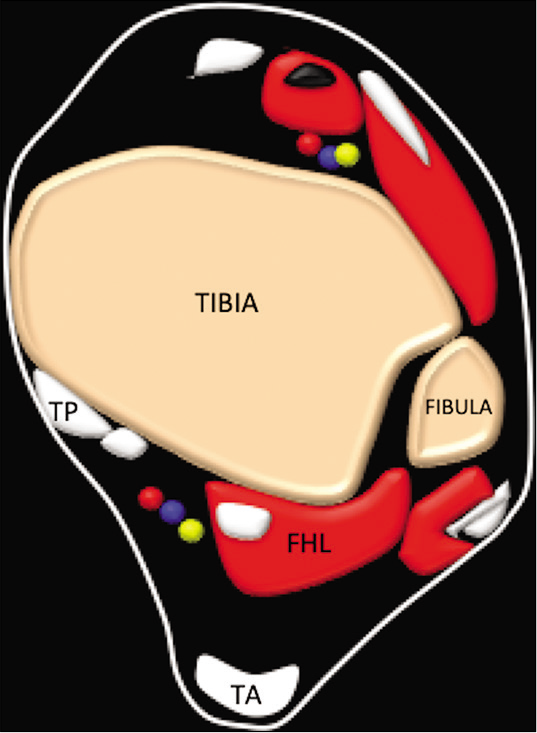 Diagrammatic representation of the axial image of the ankle demonstrating the flexor hallucis longus, tibialis posterior (TP) tendon Achilles.