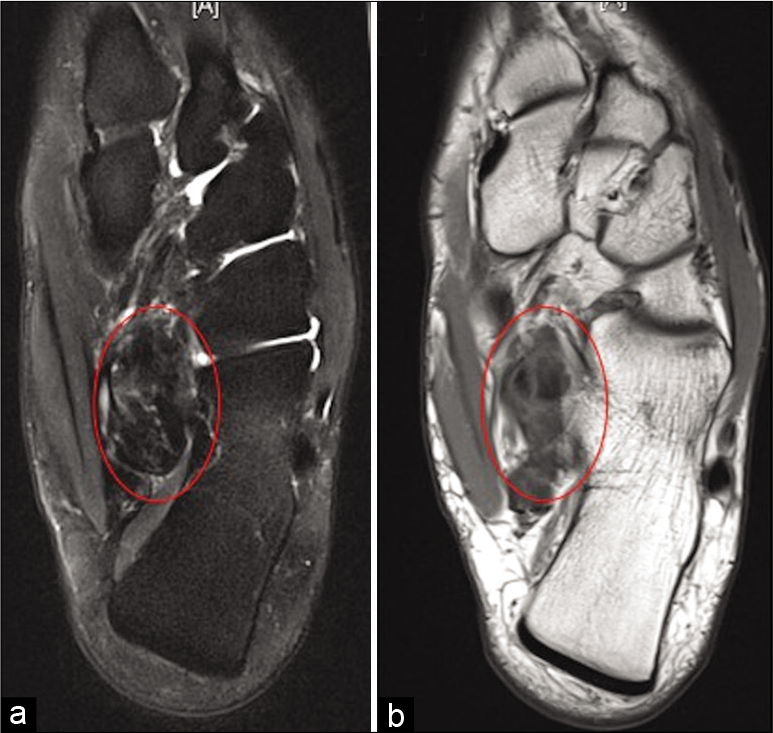 Axial PDFS (a), PD (b), and coronal PDFS (c) show low signal lesion in relation to flexor hallucis longus at the level of master knot of Henry in keeping with giant cell tumor of tendon sheath (red circle).
