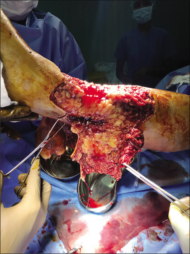 Intraoperative status of the leg.