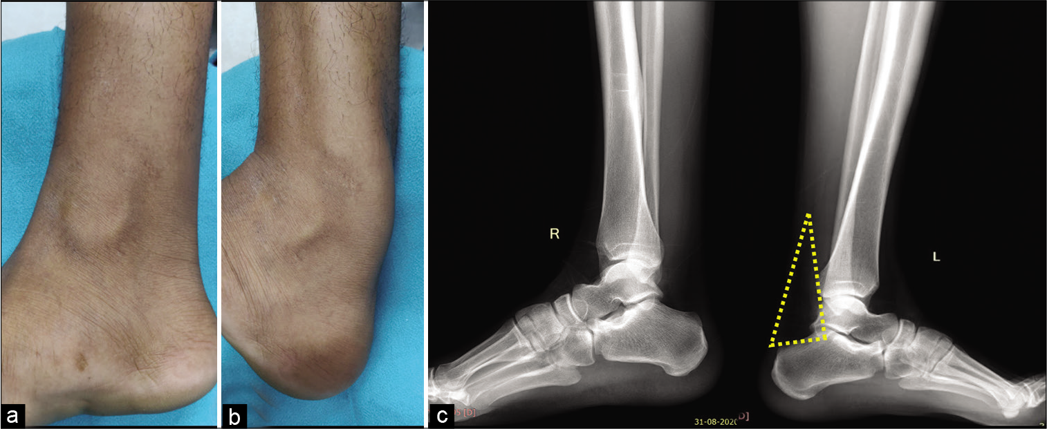 Clinical examination reveals soft-tissue bulge along the medial aspect of leg and ankle on dorsiflexion (a and b). Lateral radiographs of both ankles with lower legs reveal obscuration of normal radiolucency of Kager’s fat pad on the right side (c).