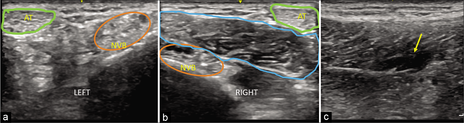 High-frequency linear ultrasound transverse-oblique images along the postero-medial ankle (a) normal left side, (b) abnormal right side and (c) longitudinal scan right side. Green circle demarcates the Achilles tendon (AT), orange circle indicates the posterior tibial neurovascular bundle (NVB). There is presence of muscle like structure (blue circle) displacing AT and NVB on right side (2b). Longitudinal scan (c) along the right inferior myo-tendinous junction of the accessory soleus muscle shows ill-defined hypoechogenicity with loss of muscle fiber continuity (~5% muscle involvement) s/o sprain (yellow arrow).