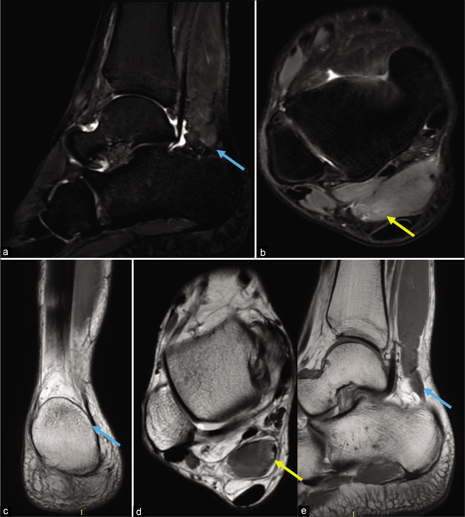 Sagittal Short time to inversion recovery (STIR) (a), Axial proton density fat-suppressed (PDFS) images (b), Coronal PD (c), Axial PD (d) and Sagittal T1 weighted MRI images (e). An abnormal structure isointense to muscle anterior to Achilles tendon is seen inserting along the medial aspect of the calcaneum (a,c,e) (blue arrows). Axial PDFS and PD non fat suppressed images (b and d) reveal focal intrafascicular edema in the form of hyperintensity along the inferior aspect of the muscle with focal discontinuity along the myotendinous junction (yellow arrows). Posterior tibial nerve appears normal.