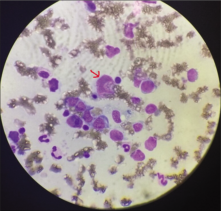 Bone marrow aspirate showing atypical lymphocytes (arrow).