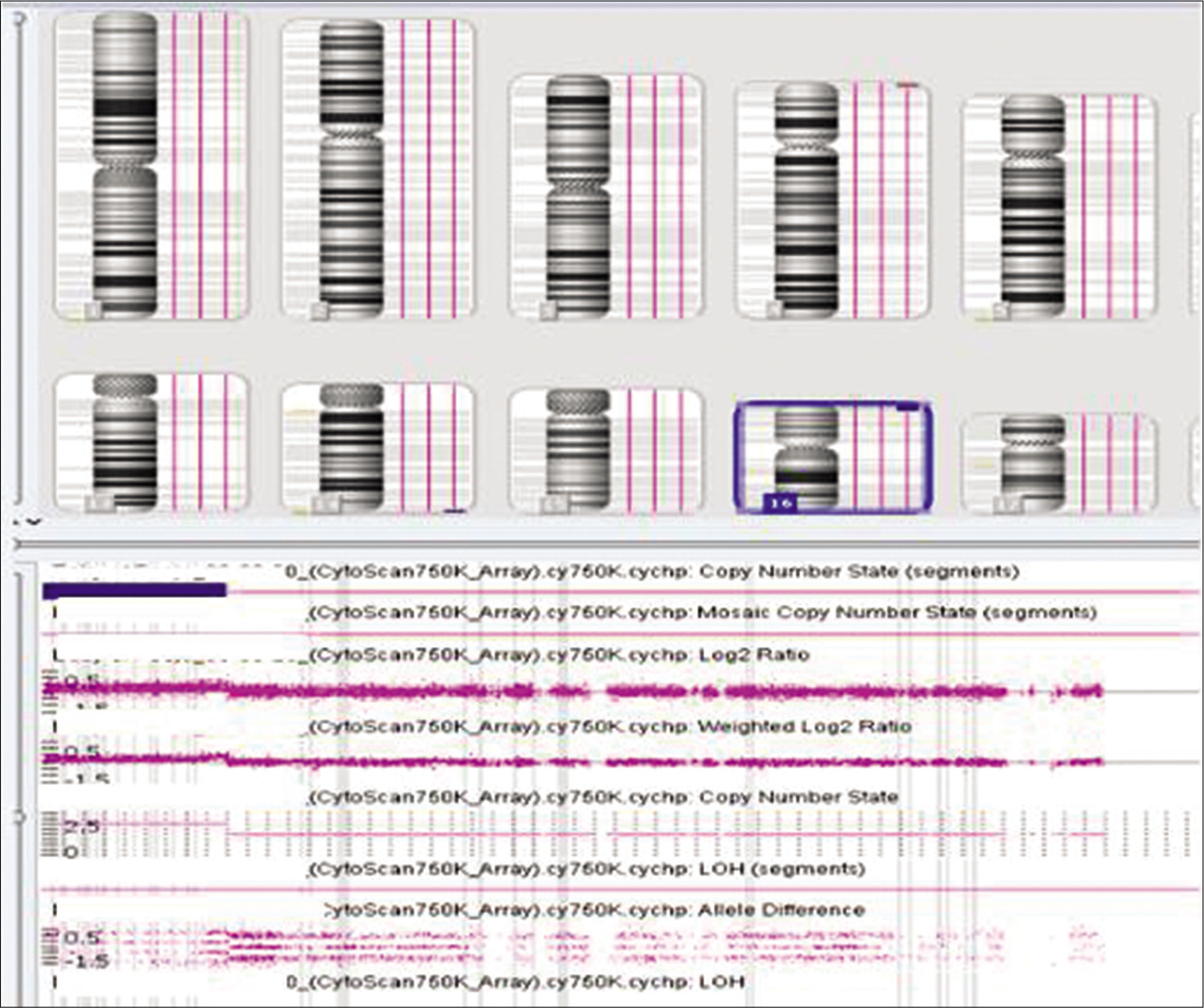 Array comparative genomic hybridization finding of gain over 16p.