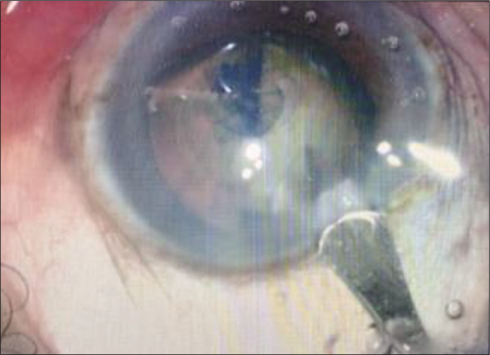 Construction of the clear corneal main incision.