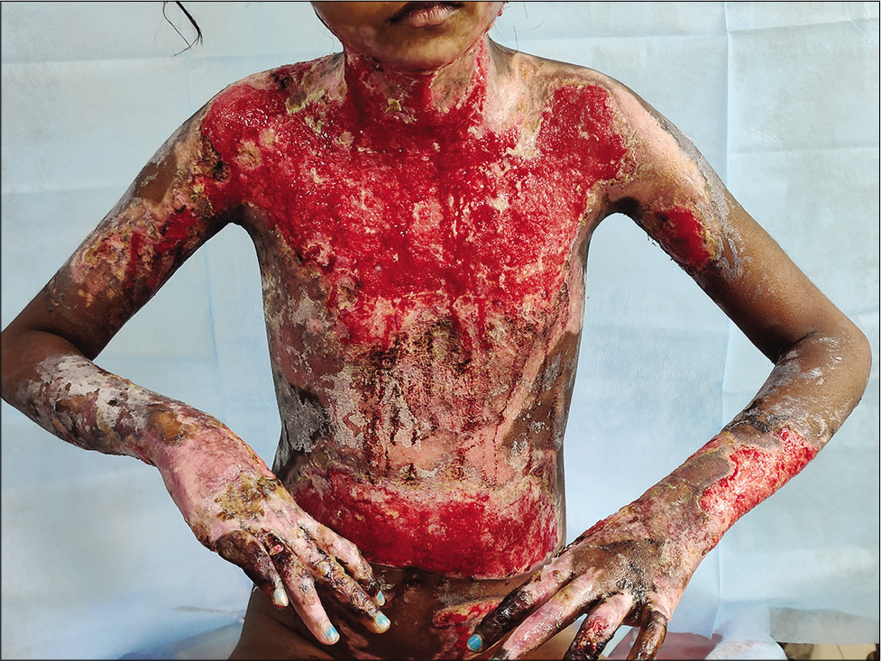 Twenty-five percent total body surface area burns in a 10-year-old girl, involving the chest and upper limbs.