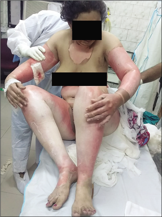 Seventy percent total body surface area burns in a 30-year-old female health worker, involving the chest, back, and upper and lower limbs.