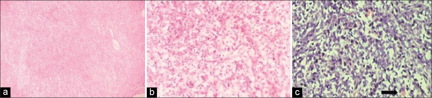 (a) Scanner view showing cells arranged in fascicles and vague storiform pattern. (H and E; ×40), (b) High power view showing liopsarcomatous areas. (H and E; ×100); (c) Occasional rhabdomyoblast seen. (Arrow pointing in H and E; ×100).