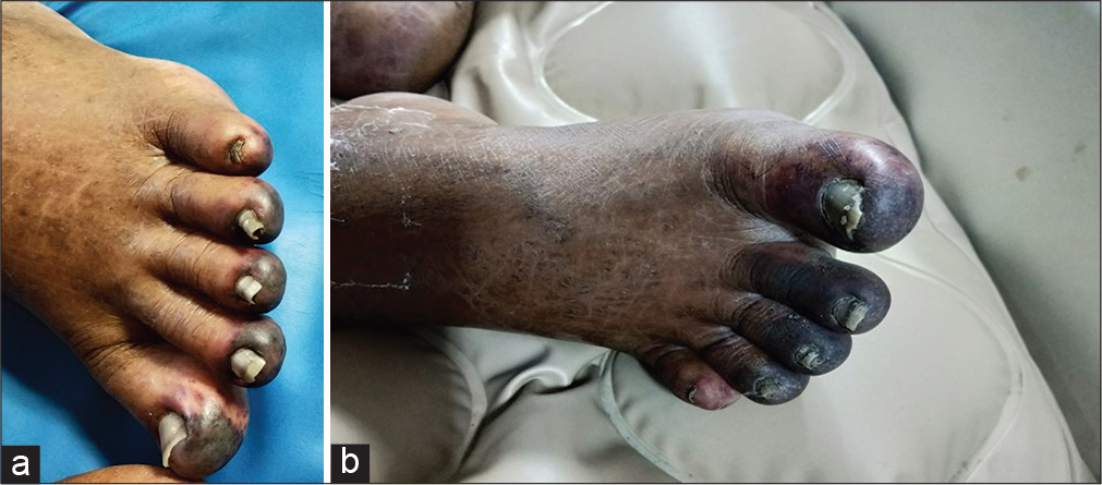 (a) Gangrenous change involving left toes and (b) gangrenous change in the right toes.