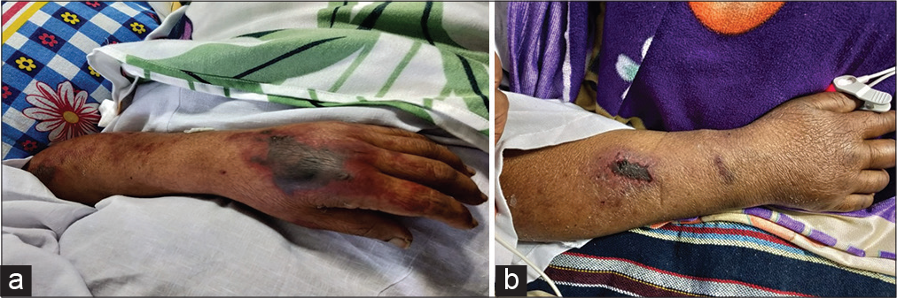(a) Gangrenous change in the dorsum of the left hand and (b) gangrenous change in the right hand.