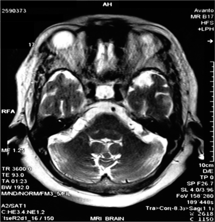 Magnetic resonance imaging brain showing empty sella with pituitary stalk in axial section.