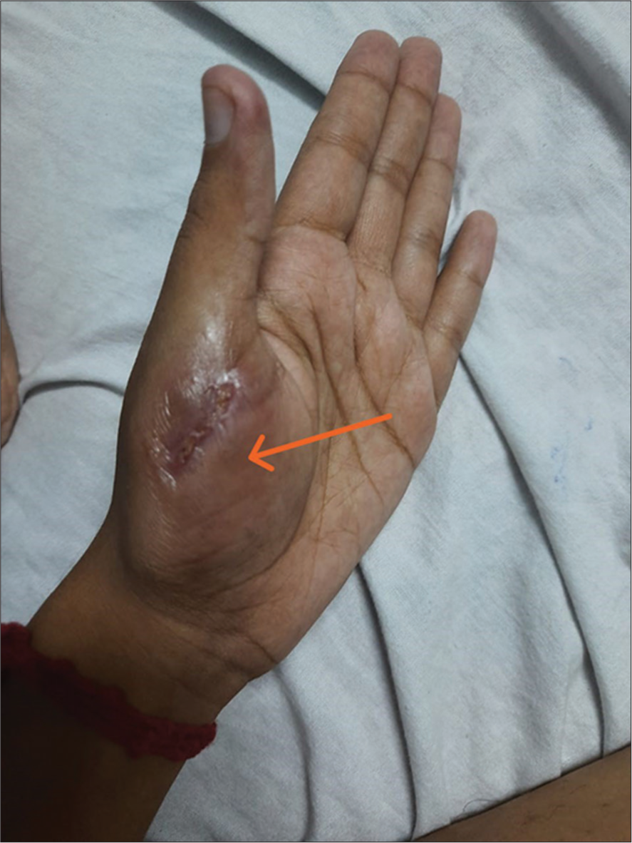 Fluid filled lesion over left hand (orange arrow).