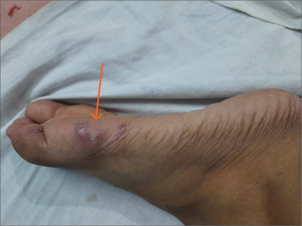 Lesion on right foot (orange arrow).