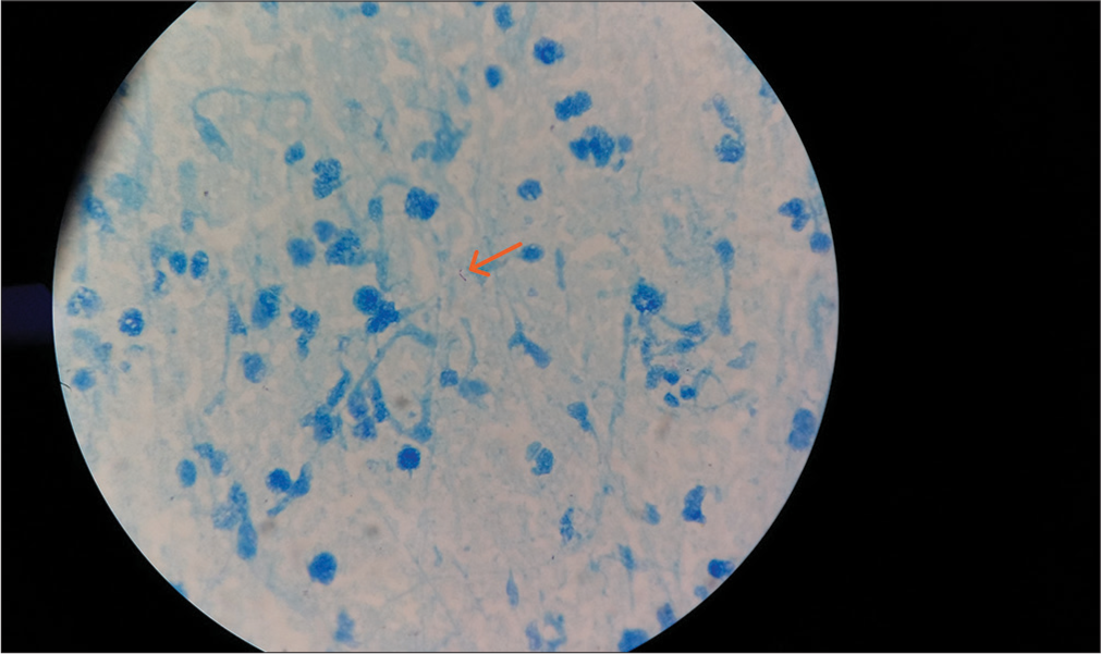 Ziehl Neelsen stain-Acid fast bacilli lying singly (orange arrow) (×1000).