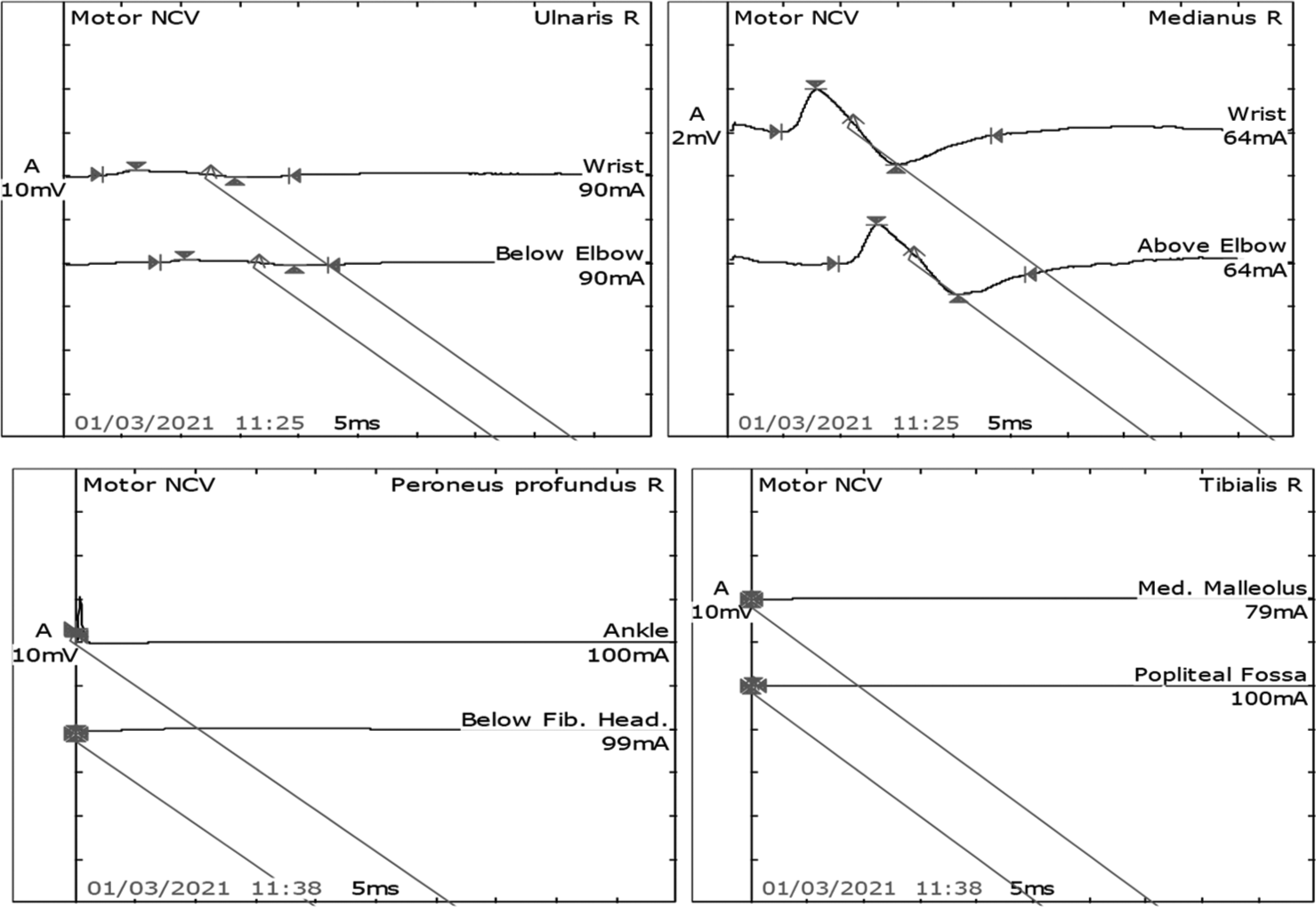 Motor Nerve conduction study in the right median and ulnar nerves showed normal latency, reduced amplitude, and normal velocity. However, the right peronial and tibial nerves latency, amplitude, and velocity were not recordable.