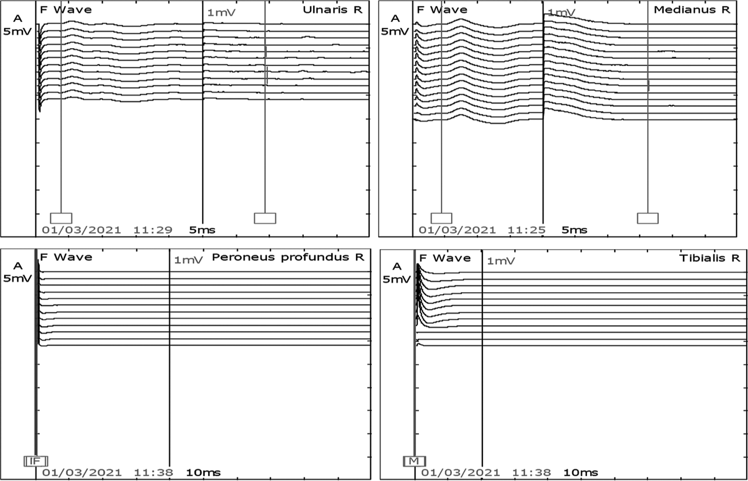 F waves in the right median and ulnar nerves were present. However, peroneal and tibial nerve was not recordable.