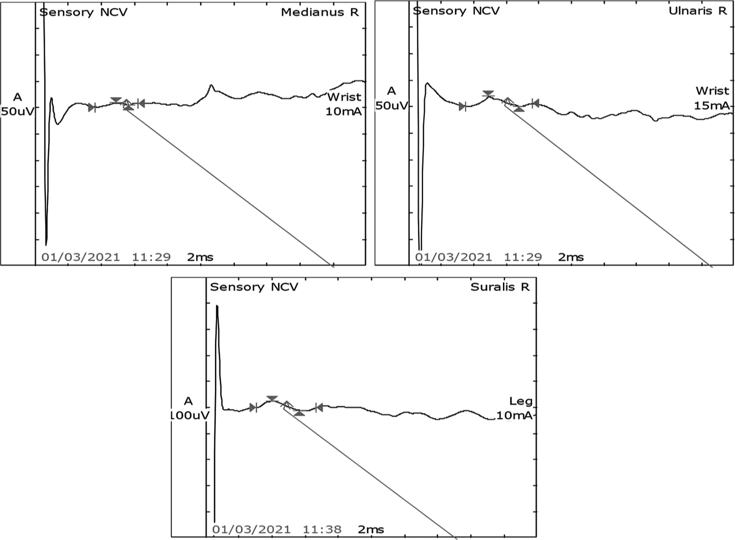 Sensory nerve conduction study showed normal latency, amplitude, and velocity in the right median, ulnar, and sural nerves.