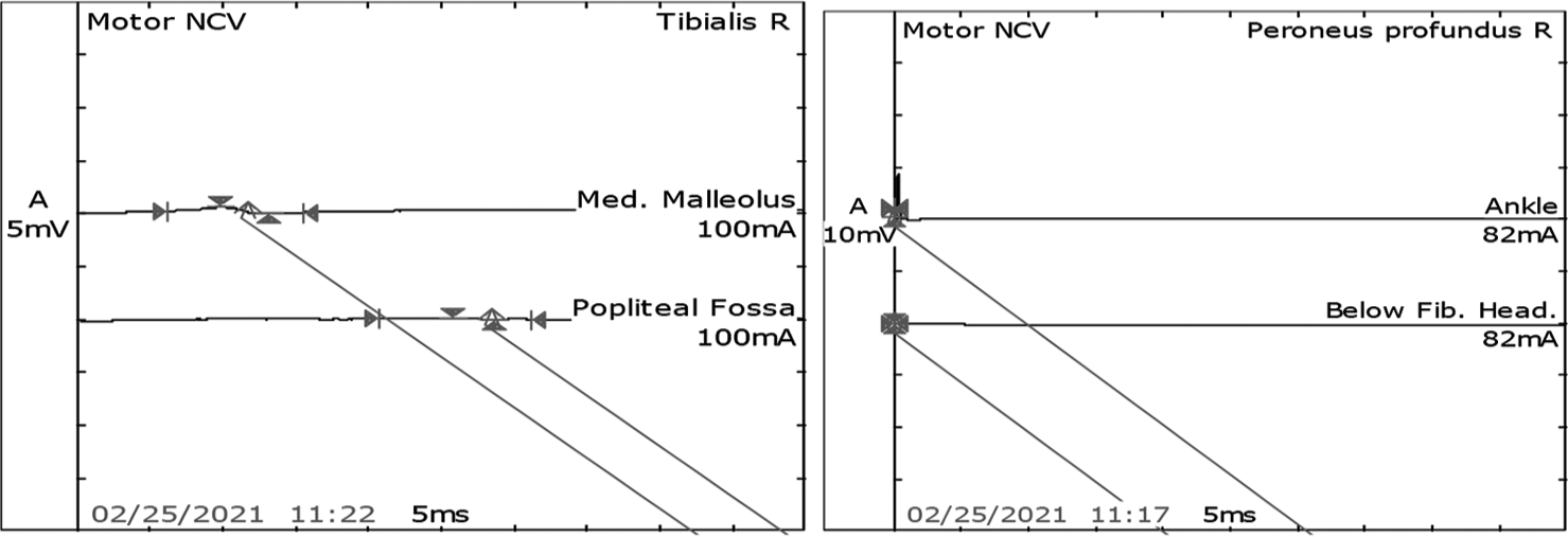 Post-intravenous immunoglobulin motor nerve conduction study in the right tibial nerve showed mild improvement in increased latency, reduced amplitude, and reduced velocity. However, the right peronial was still not recordale.