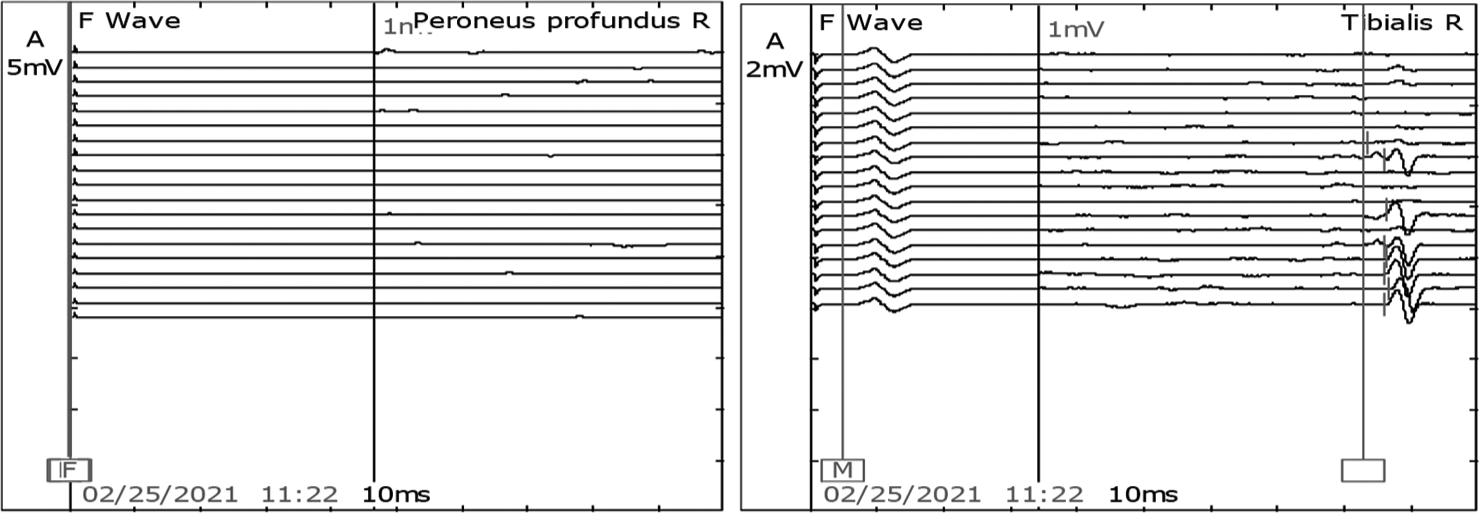 Post-intravenous immunoglobulin F waves in the right tibial nerve was present. However, the right peroneal was not recordable.