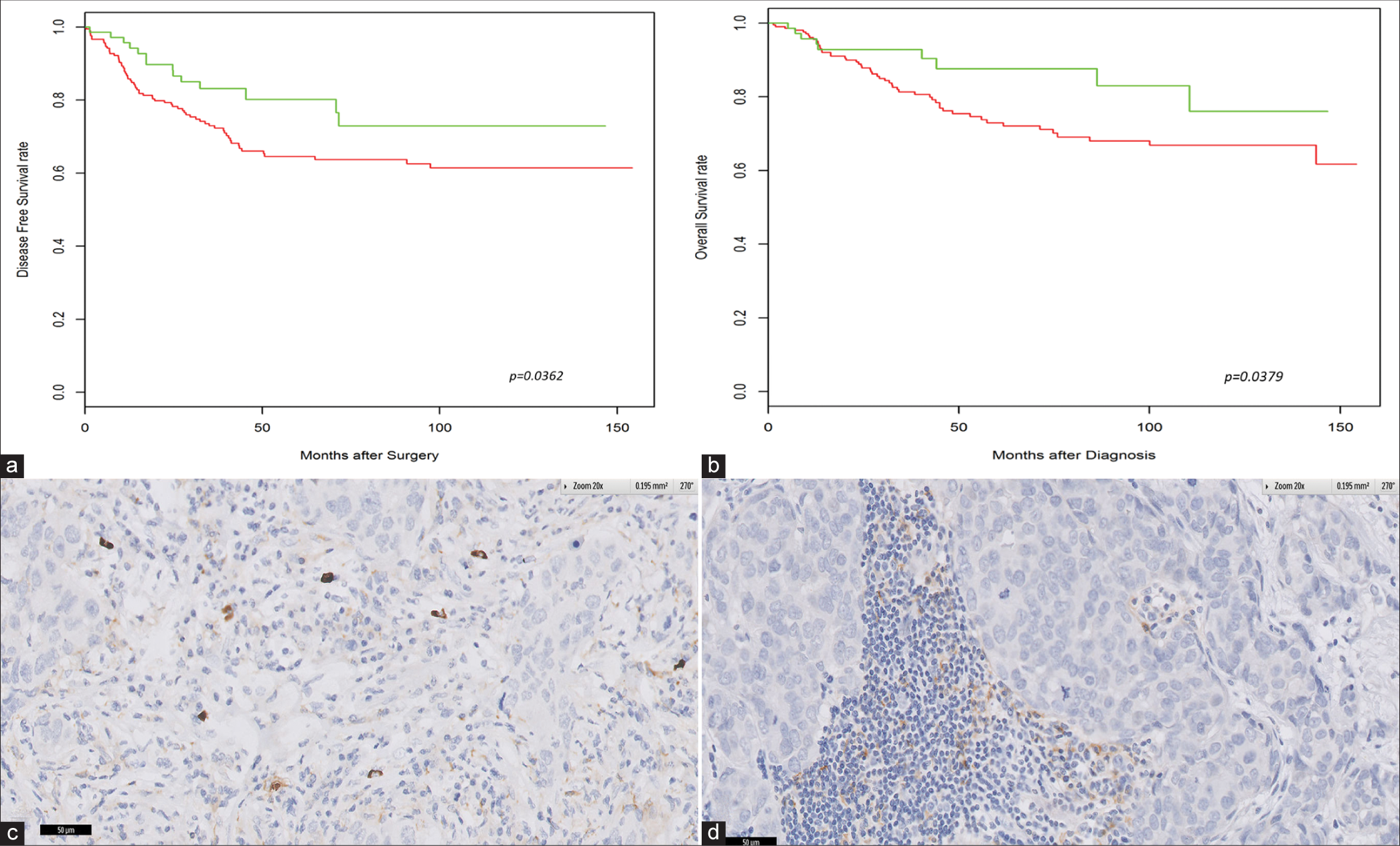 High densities of programmed death ligand (PD-L2)-positive cells are associated with better clinical outcome in triple negative breast cancer. Kaplan–Meier analysis of (a) disease-free survival and (b) overall survival. (c and d) Correlation of PD-L2 positivity in tumor cells with PD-L1 positivity in the tumor cell membrane.