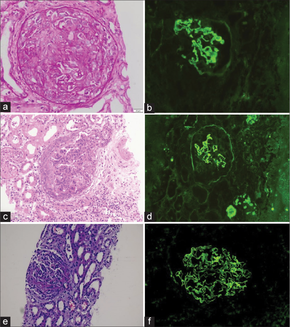 Case 1: (a) Cellular crescent (PAS ×40) with (b) linear immunoglobulin G (IgG) on immunofluorescence. Case 2: (c) Low-power view shows a cellular crescent with marked neutrophilic exudation in the underlying tuft along with red blood cell casts (Hematoxylin and Eosin ×10). (d) Immunofluorescence shows linear staining of capillary walls and glomerular basement membrane. Case 3: (e) Cellular crescent with fibrinoid necrosis and occasional red blood cell casts (MT ×10) (f) Linear IgG staining on glomerular capillary walls. MT: Masson trichrome stain, PAS: Periodic acid-schiff.