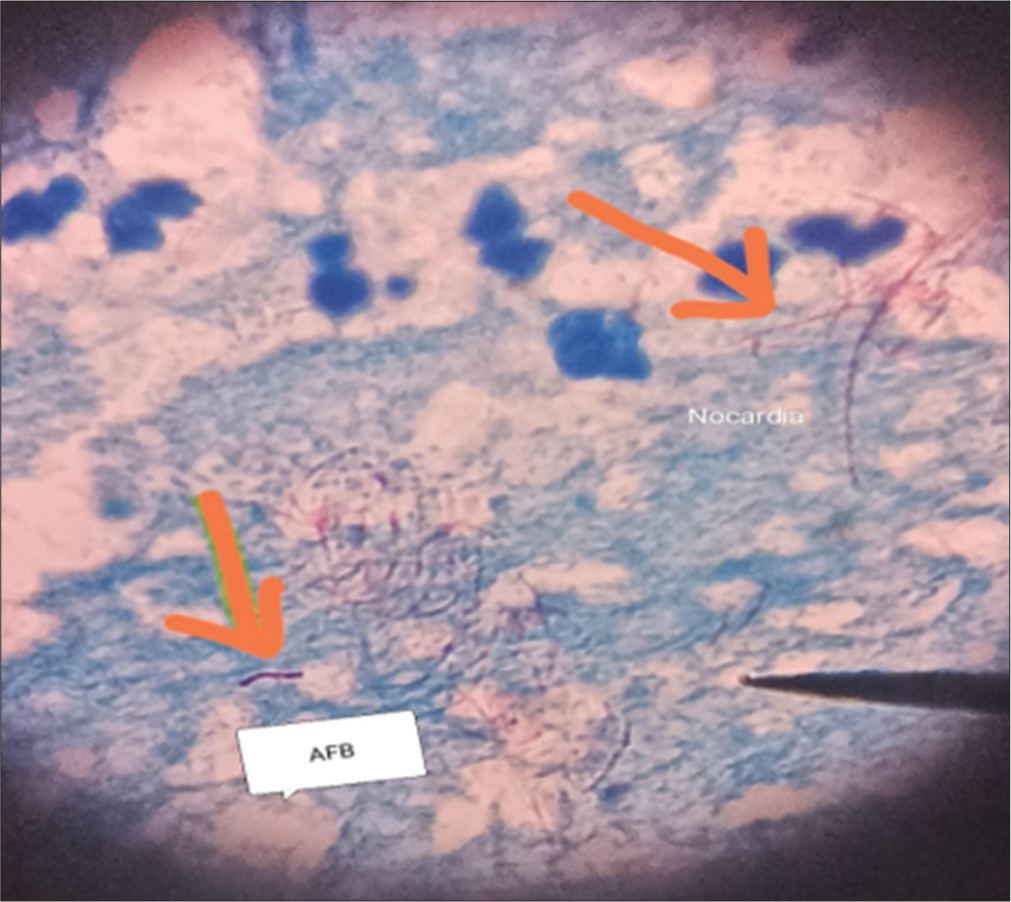 Ziehl-Neelsen stained smear showing Mycobacterium spp. and thin branching acid- fast bacteria (Nocardia spp.).