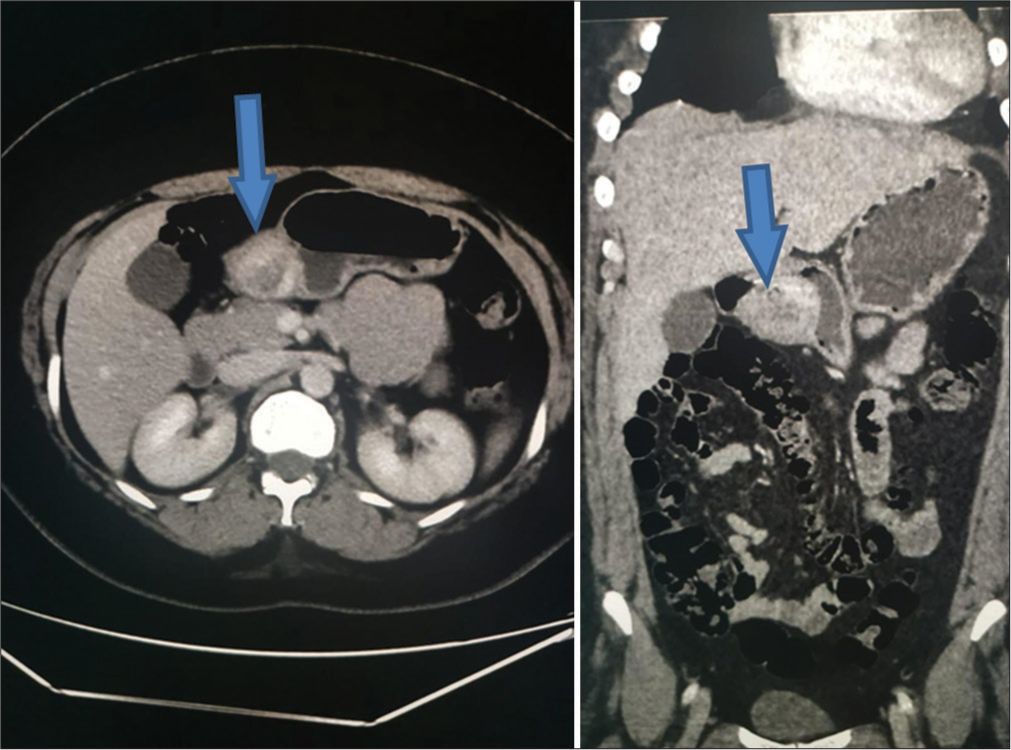 Computed tomography scan view shows a smooth submucosal rounded heterogeneously enhancing lesion with areas of hypodensities within protruding intraluminally (blue arrows). Small calcified focus noted within.