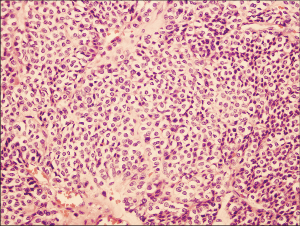 The tumor shows large nests and sheets of uniform polygonal to round cells, containing scant cytoplasm with focal cytoplasmic clearing. The left lower periphery shows dilated blood vessels. Hematoxylin and eosin stain (H&E), magnification power 20X.