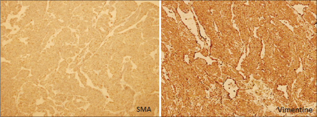 The tumor cells are polygonal to round in shape, with scant cytoplasm and focal cytoplasmic clearing. Left side: Smooth muscle actin immunohistochemistry show diffuse positivity. Right side: Vimentin immunohistochemistry is diffusely positive. (Magnification power 5x).
