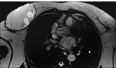 A 53-year-old female presented with a palpable lump in her right breast. Axial T2-weighted magnetic resonance image shows a well-defined thin-walled predominantly hyperintense lesion with multiple small cysts (daughter cysts) within it in the right breast; Features consistent with a Type III (CE3b) hydatid cyst.