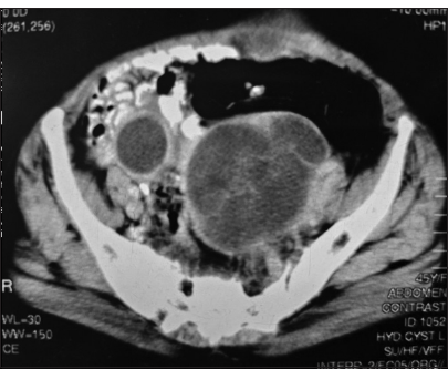 A 45-year-old male with intermittent abdominal pain. Axial contrast-enhanced computed tomography abdomen image shows a large, well-defined, multiloculated hypodense cystic lesion in the retroperitoneum with enhancing walls and septations, findings indicative of a retroperitoneal hydatid cyst. Surrounding inflammatory changes and displacement of the adjacent bowel loops seen.