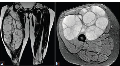 A 28-year-old female presented with swelling in the right thigh. (a) Coronal T2W and (b) axial T2 FS images of magnetic resonance image show multiple multiloculated hyperintense cystic lesions with a hypointense rim in the anterior muscle group of the right thigh, favoring a diagnosis of intramuscular hydatid cyst. FS: Fat suppression.