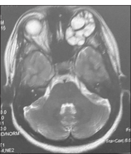 A 21-year-old female with proptosis of the left eye. Axial T2-weighted magnetic resonance image of the orbit shows a hyperintense, multiloculated cystic lesion in the left orbit with hypointense rim and septations, consistent with hydatid cyst.